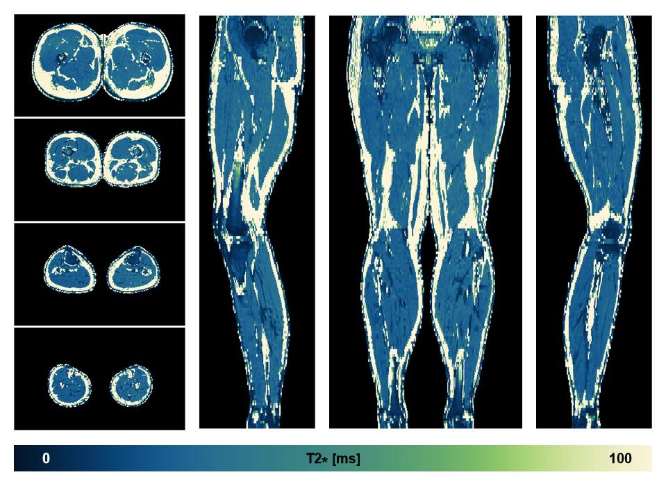 The T2 star relaxation time of the lower extremity obtained from the dixon reconstruction for muscle water fat quantification.